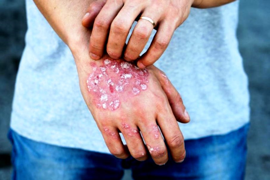 Rating of the best remedies for psoriasis for 2022