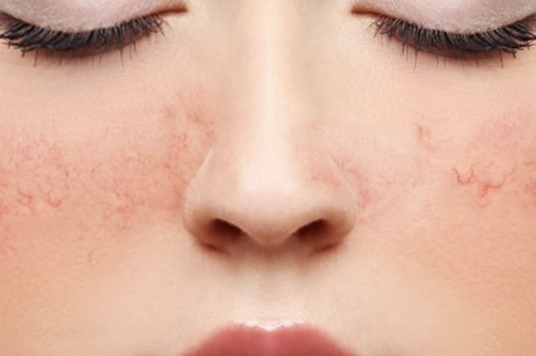 Rating of the best creams for rosacea for 2022