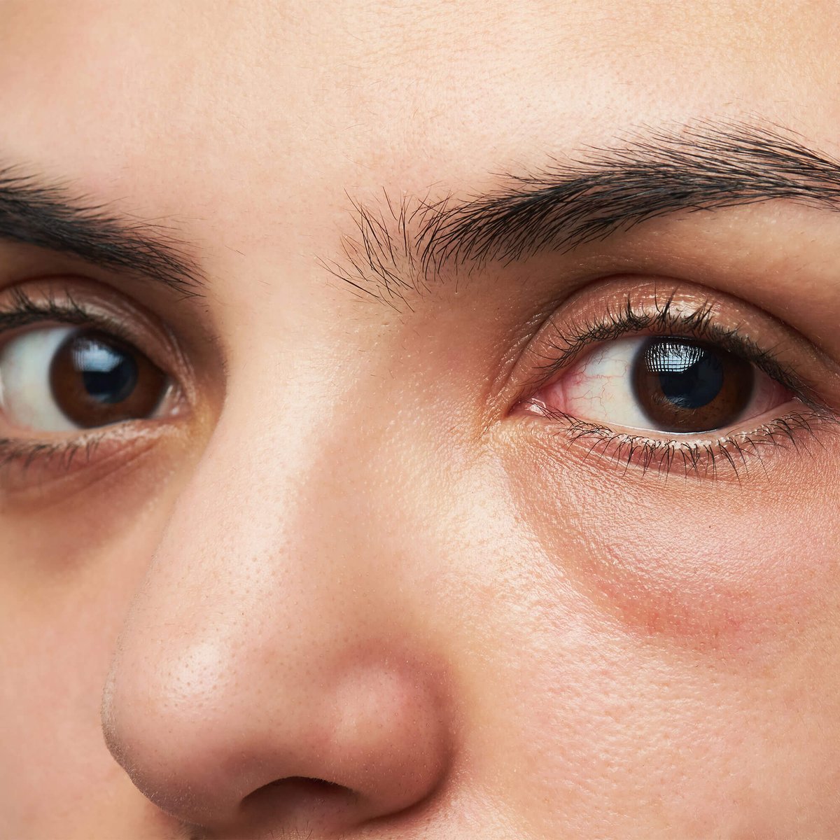 Ranking of the best remedies for dark circles under the eyes for 2022